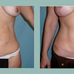 Abdominoplastía: Fotos de Casos - Antes y Después