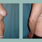 Abdominoplastía: Fotos de Casos - Antes y Después