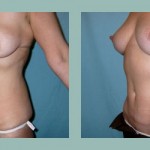 Abdominoplastía: Fotos de Casos - Antes y Después