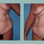 Abdominoplastía: Fotos de Casos - Antes y Después