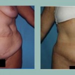 Abdominoplastía: Fotos de Casos - Antes y Después