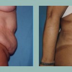 Abdominoplastía: Fotos de Casos - Antes y Después