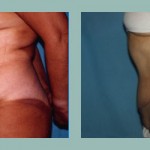 Abdominoplastía: Fotos de Casos - Antes y Después