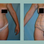 Abdominoplastía: Fotos de Casos - Antes y Después