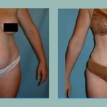 Abdominoplastía: Fotos de Casos - Antes y Después