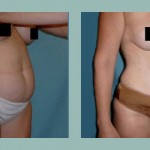 Abdominoplastía: Fotos de Casos - Antes y Después