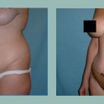 Abdominoplastía: Fotos de Casos - Antes y Después