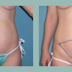 Abdominoplastía: Fotos de Casos - Antes y Después