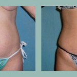 Abdominoplastía: Fotos de Casos - Antes y Después