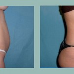 Abdominoplastía: Fotos de Casos - Antes y Después