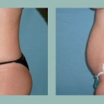 Abdominoplastia