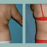 Abdominoplastia