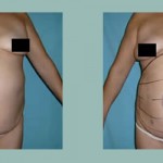 Abdominoplastia