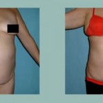 Abdominoplastia