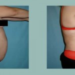 Abdominoplastia