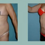 Abdominoplastia