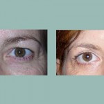 Blefaroplastia