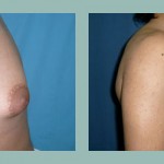 Ginecomastia: Fotos de Casos - Antes y Después