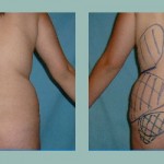 Gluteoplastía: Fotos de Casos - Antes y Después