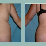 Gluteoplastía: Fotos de Casos - Antes y Después