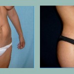 Gluteoplastía: Fotos de Casos - Antes y Después