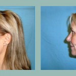 Lifting de Cara y Cuello: Fotos de Casos - Antes y Después