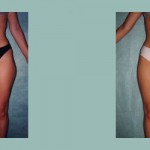 Lipoescultura - Lipoaspiración