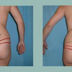 Lipoescultura - Lipoaspiración