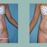 Lipoescultura - Lipoaspiración