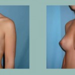 Mastoplastia - Aumento mamario