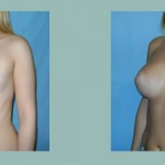 Mastoplastia - Aumento mamario