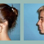 Rinoplastia - cirugia de nariz. Antes - después