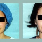 Rinoplastia