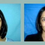 Rinoplastia - cirugia de nariz. Antes - después