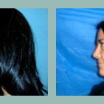 Rinoplastia - cirugia de nariz. Antes - después