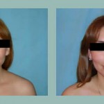 Rinoplastia