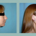 Rinoplastia