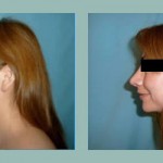 Rinoplastia